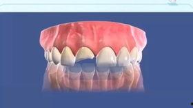 成人牙齿缺失修复视频,跟随视频学习现代修复技术
