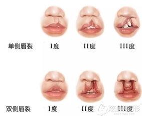 成人唇腭裂正畸视频大全