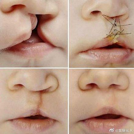 成人唇腭裂正畸视频大全