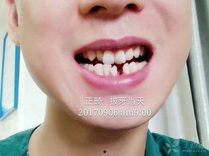 成人唇腭裂正畸视频大全