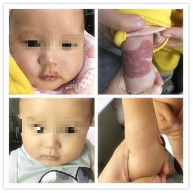 血管瘤成人打针视频,注射疗法操作过程揭秘