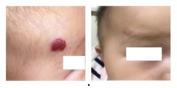 血管瘤成人打针视频,注射疗法操作过程揭秘